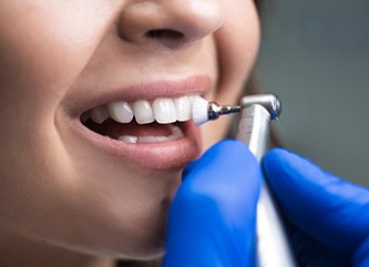 Closeup of patient’s teeth being polished by hand in blue glove