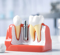 a dental implant model