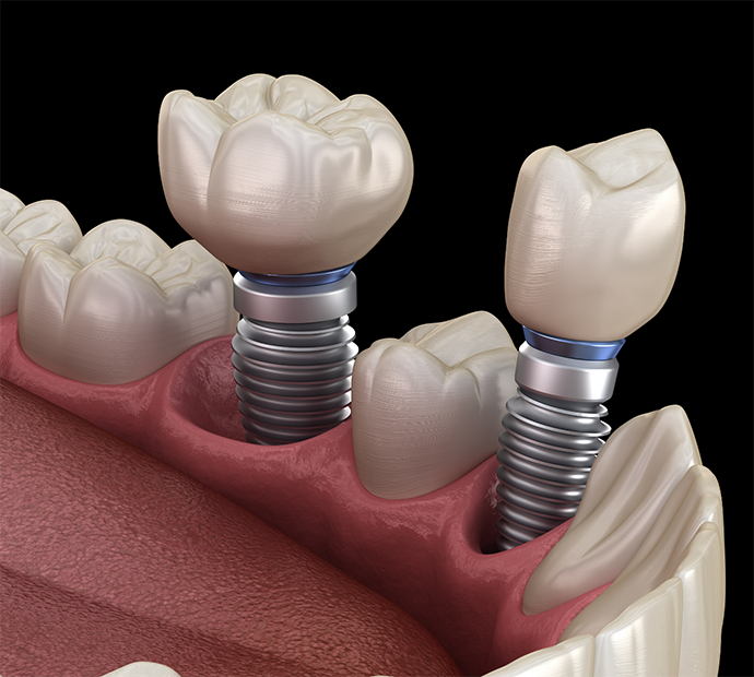 Illustration of dental implants in Dix Hills in the lower jaw