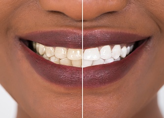 Closeup of patient's smile before and after teeth whitening