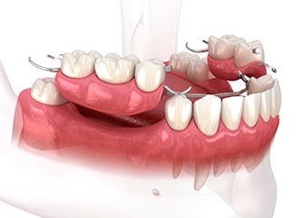 Illustration of partial denture for lower arch