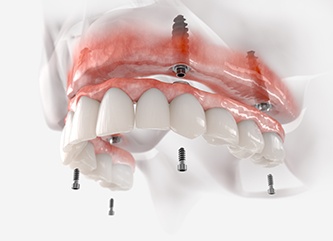 Illustration of permanent implant denture for upper dental arch