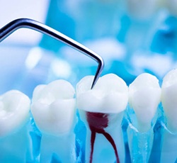 Model of root canal procedure