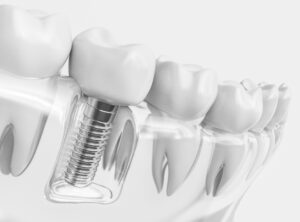 Model of dental implant for lower tooth